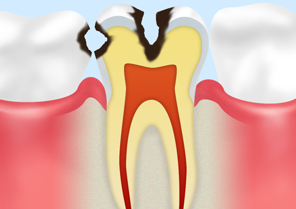 C2：象牙質まで達した虫歯