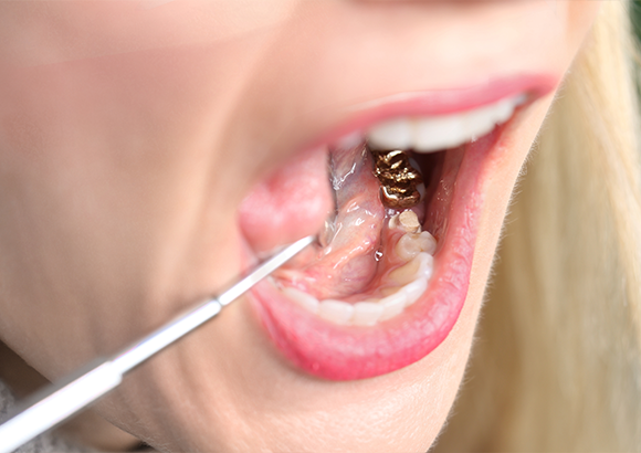 銀歯は全身に影響を及ぼす？