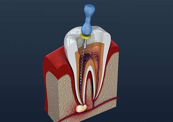 重度の虫歯（根管治療）