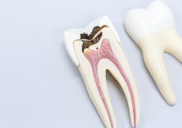 虫歯の進行度合いによって治療の内容も変わります